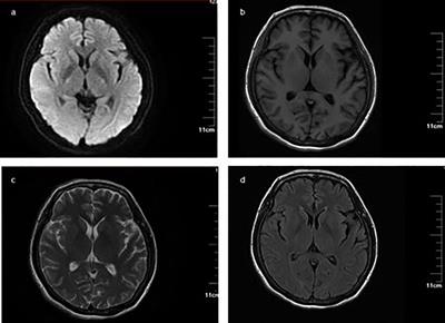 A rare presentation of acute-onset chronic inflammatory demyelinating polyneuropathy with the detection of anti-GM3 and anti-sulfatides antibodies: a case report